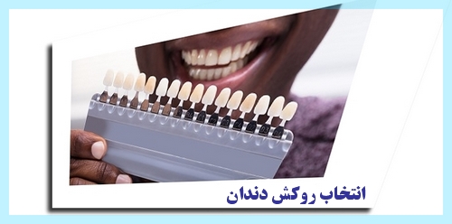 انتخاب روکش دندان :