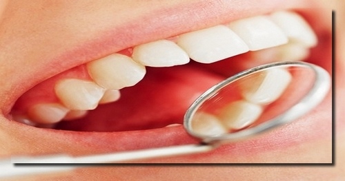 آبسه دندان چیست و چگونه درمان میشود انواع مختلف آن چیست؟