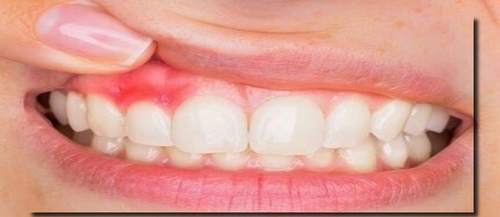 آبسه دندان چیست و چگونه درمان میشود انواع مختلف آن چیست؟