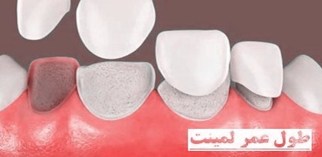 طول عمر لمینت های سرامیکی ثابت یا متحرک دندان 