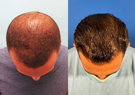 عکس مطلب مزایا ، مراحل و مراقبت بعد از کاشت موی ترکیبی