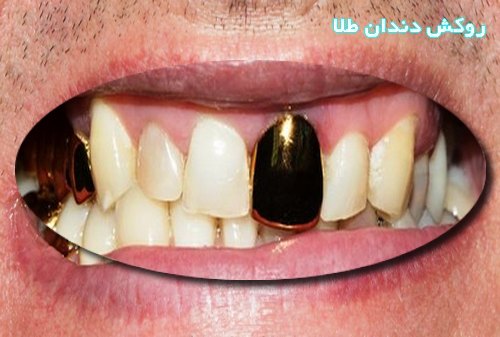 روکش دندان طلا