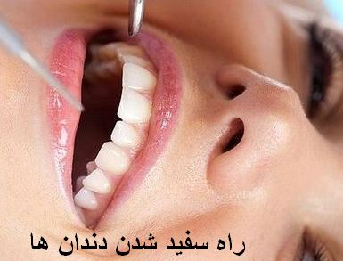 سفید کردن دندان همراه با توضیحات در مورد محصولات سفید کننده