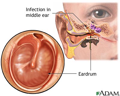علت و درمان عفونت گوش 