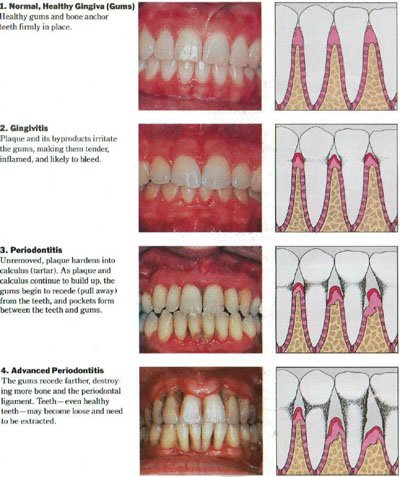 تمیز کردن دندان و لثه و نشانه التهاب