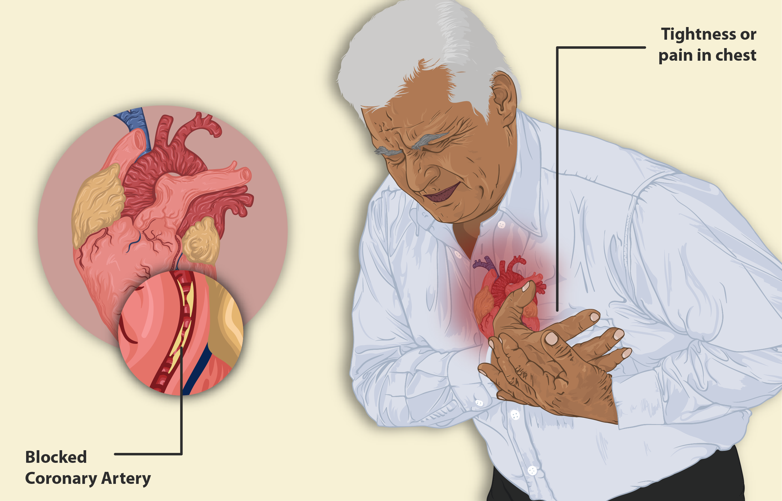 علت و نشانه های حمله قلبی چیست ؟
