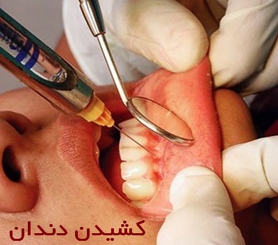 عفونت بعد از کشیدن دندان 