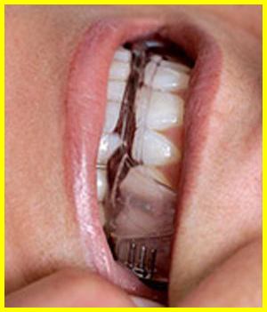 انواع محافظ دهان و دندان  را بهتر و کاملتر بشناسید