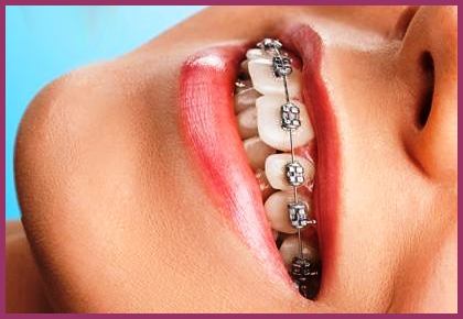 دندان ارتودنسی  چیست یعنی چه + انواع ارتودنسی بهترین نوع بریس های ثابت