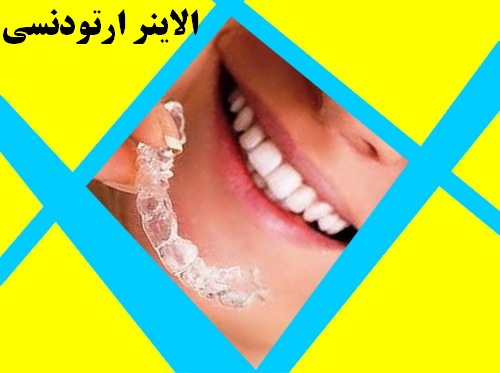 الاینر ارتودنسی در روز باید چند ساعت استفاده شود+توضیحات موشکافانه