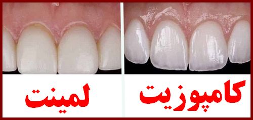 کامپوزیت سرامیکی یا لمینت