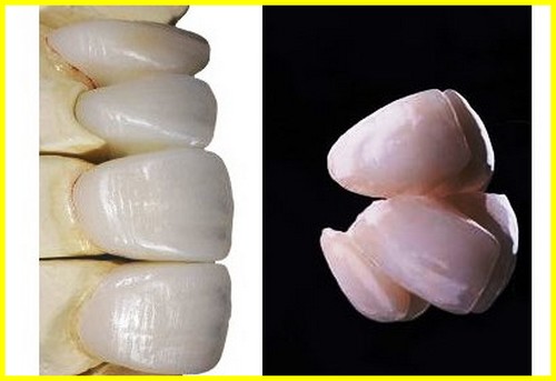 لمینت ونیز دندان از چه چیزی ساخته شده اند +ایمکس توضیحات اجمالی